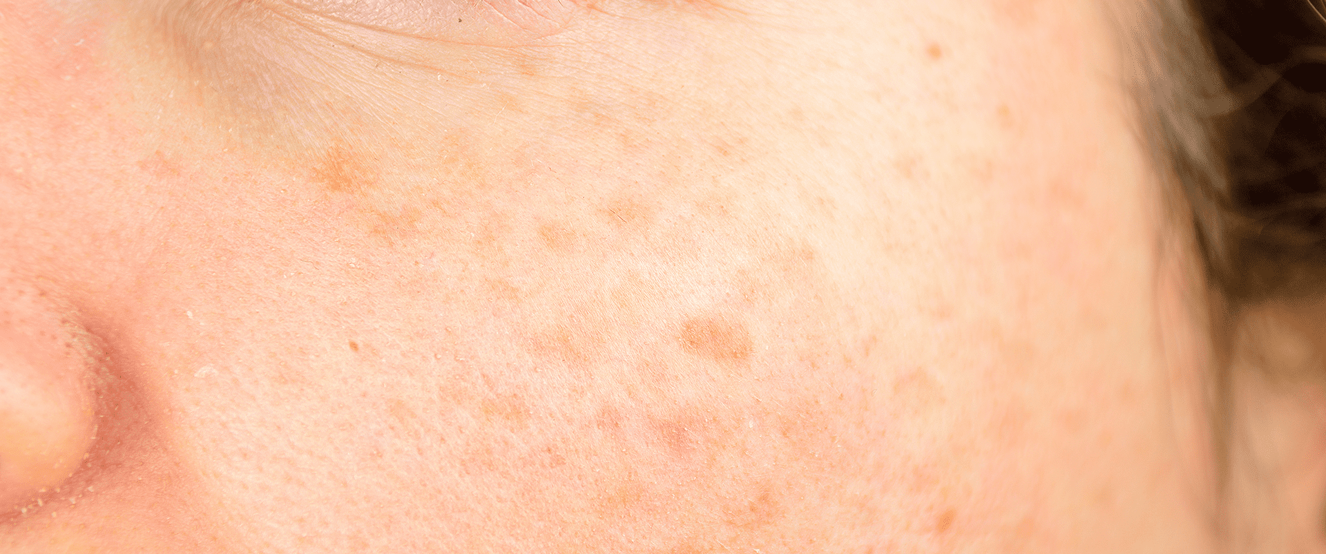 Melasma, Freckles, Sun Spots