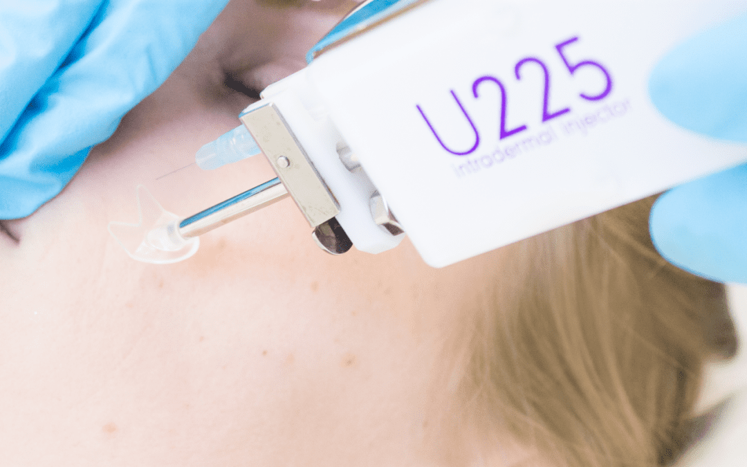 Microneedling and Mesotherapy
