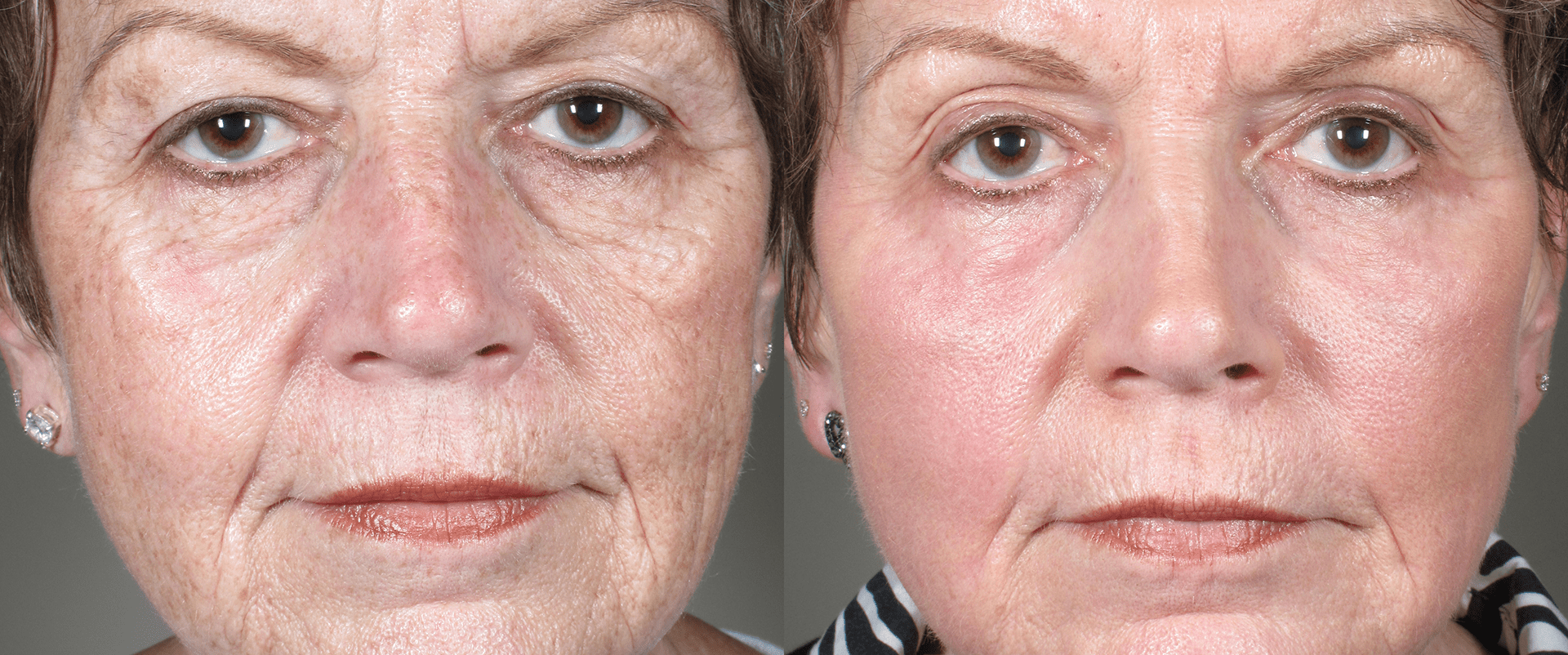 Top Reasons Why Fractional CO2 Laser Skin Resurfacing Works Well