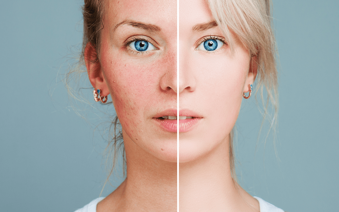 Redness and Rosacea
